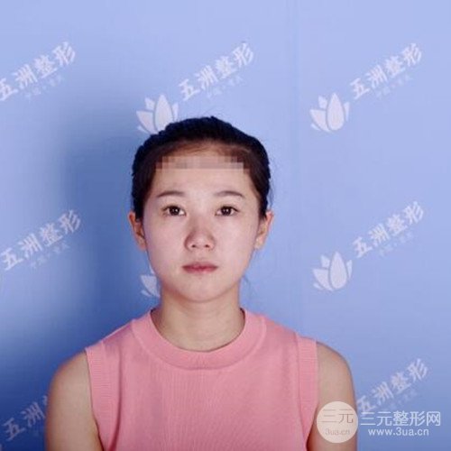 重慶五洲范文亮自體肋軟骨隆鼻案例前后對(duì)比圖分享~