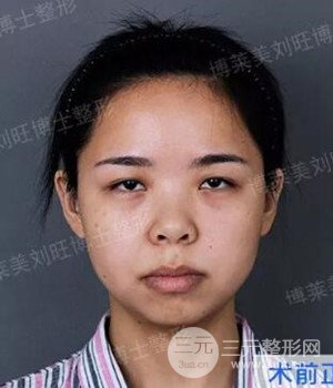 天津博萊美肋劉旺軟骨隆鼻整形+下頦整形案例前后對(duì)比圖分享~