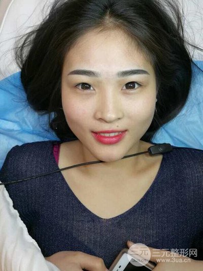 華人醫(yī)聯(lián)馬麗醫(yī)生膨體隆鼻日記分享