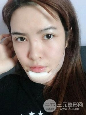 廣州廣美硅膠墊下巴恢復(fù)過(guò)程|前后對(duì)比照分享