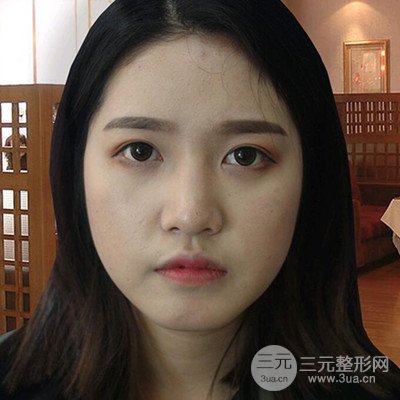 肖凌做的隆鼻整形，分享恢復(fù)過(guò)程圖~