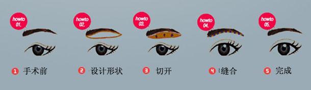 做切眉術(shù)降低風險嗎 切眉術(shù)風險大不大