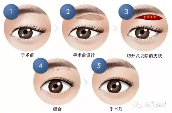 做切眉術(shù)降低風險嗎 切眉術(shù)風險大不大