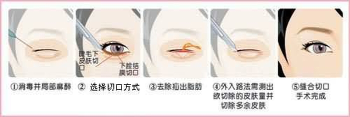 眼袋外切和內(nèi)切的區(qū)別
