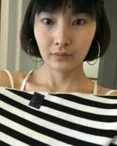 微創(chuàng)開內(nèi)眼角后眼睛好看多了