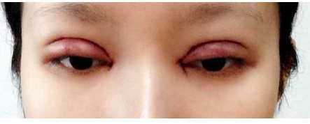 全切雙眼皮+去皮去脂+開(kāi)眼角一個(gè)月了~