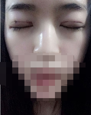 做埋線雙眼皮一周啦~果滿滿的！