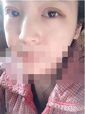 做埋線雙眼皮一周啦~果滿滿的！