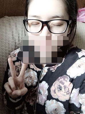 做埋線雙眼皮一周啦~果滿滿的！