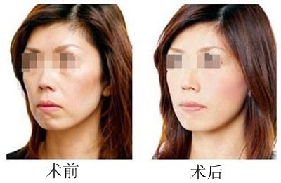 廈門做拉皮除皺大概需要多少錢