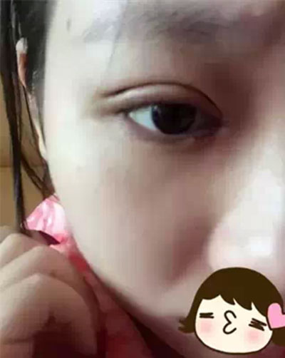 深圳希思做的雙眼皮+開眼角 感謝楊醫(yī)師！