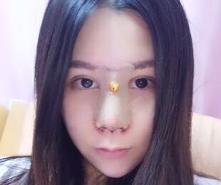 以前做過鼻子,但是不好看,山根那個地方太奇怪了,形狀不太協(xié)調(diào),聽說趙士俊醫(yī)生做鼻子修復很好,就慕名而來啦,放心的把自己的鼻子交給他,后來的果沒有讓我失望哦。 之前做的鼻子,奇怪吧。 做了手術(shù)之后打了消炎針,漏掉一天沒搭,傷口就發(fā)紅泛腫了,簡直嚇人,趕緊去醫(yī)院打消炎,喝白粥度日。 沒拆紗布,不過感覺已經(jīng)聽好了,拆了應該很好看的。 恢復得不錯了,穿了古裝,畫了個美美的妝,完全沒有違和感。