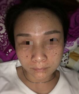 激光去黃褐斑后皮膚干凈多了呢