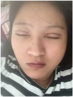 廣州麗尚做的全切開雙眼 變身混血兒