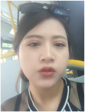 廣州麗尚做的全切開雙眼 變身混血兒