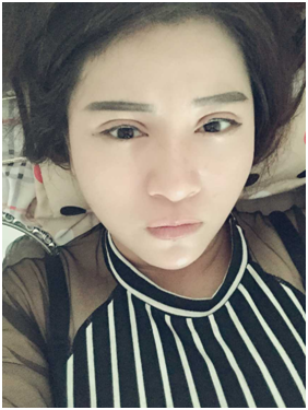 廣州麗尚做的全切開雙眼 變身混血兒