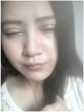 廣州麗尚做的全切開雙眼 變身混血兒
