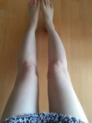 廣州麗尚大腿抽脂三個月親身經(jīng)歷