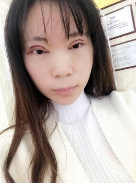 長沙美之峰重瞼+開眼角恢復(fù)過程圖