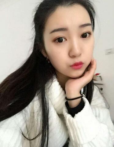 長沙美之峰割雙眼皮3個月了