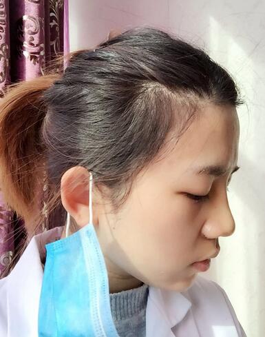 長沙美之峰假體隆鼻恢復(fù)日記