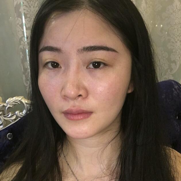 分享我的去胎記過(guò)程遺傳性雀斑終于被甩掉了