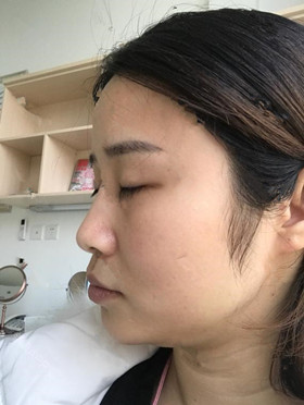 記錄了玻尿酸填充淚溝手術前后過程，還有前后對比圖哦