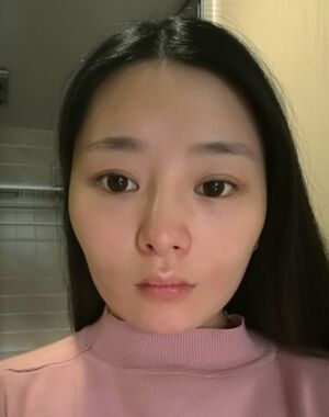 廣州曙光劉永波做的雙下巴吸脂后臉型好看多了