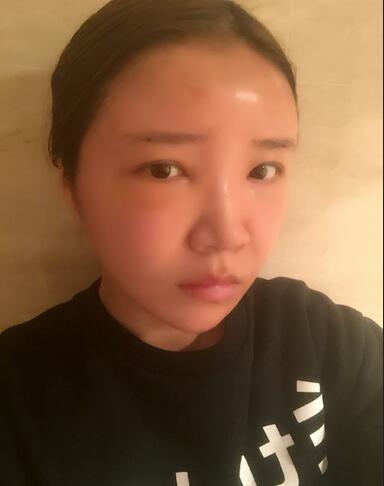 自體脂肪填充全臉1個月經(jīng)歷
