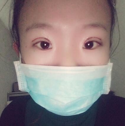 割雙眼皮術(shù)后恢復(fù)過(guò)程 全切雙眼皮3個(gè)月