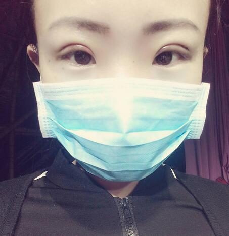 割雙眼皮術(shù)后恢復(fù)過(guò)程 全切雙眼皮3個(gè)月