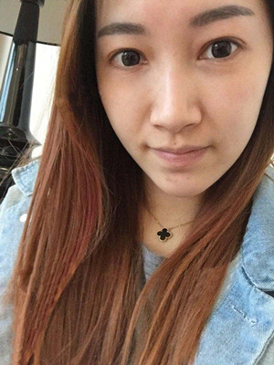 光子嫩膚真實(shí)案例分享，果真的還不錯(cuò)哦!