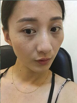 激光祛斑前后對比圖，雀斑全都沒啦