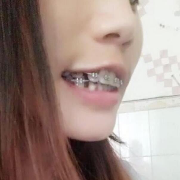 牙齒矯正的真實(shí)過程，現(xiàn)在我終于可以露出牙齒放聲大笑了