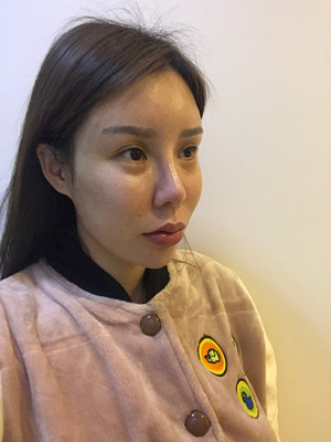 高強度聚焦超聲手術(shù)三個月的前后恢復記錄——?？诩t妝李科做的