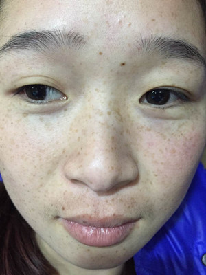 激光祛雀斑真實案例以及前后對比圖分享——?？诩t妝李杰做的