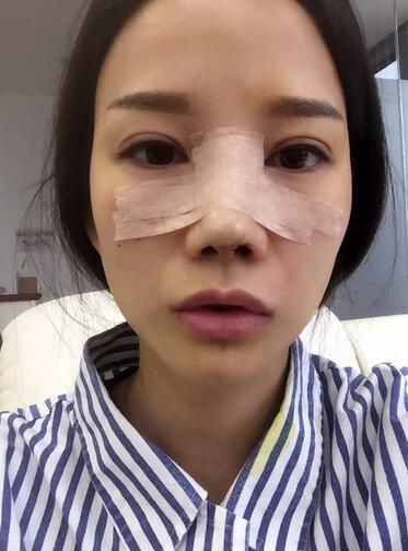 隆鼻整形真實(shí)恢經(jīng)歷 曬圖啦！