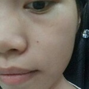 ?？诩t妝李杰醫(yī)生給我做的激光點痣，分享一下前后對比圖片