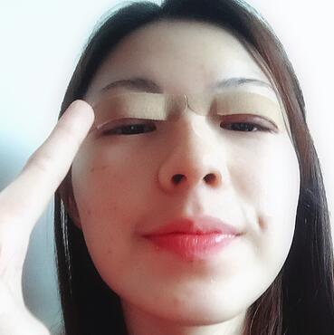 廣州凱美達(dá)微創(chuàng)雙眼皮手術(shù)恢復(fù)期紀(jì)實(shí)
