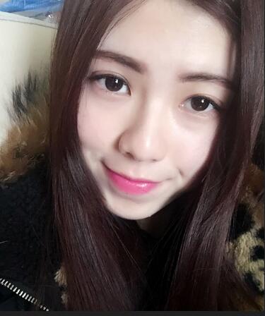 廣州凱美達(dá)微創(chuàng)雙眼皮手術(shù)恢復(fù)期紀(jì)實(shí)