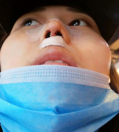 上海澳雅鼻小柱鼻中隔延長+耳軟骨鼻尖2個(gè)月的照片