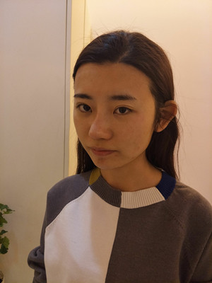 濰坊華美任傳琦醫(yī)生做的水氧嫩膚前后對(duì)比照片分享