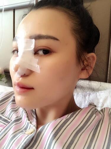 上海九院李圣利隆鼻整形真實恢復期圖片