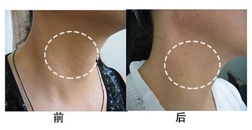 鄭州整形醫(yī)院頸部除皺大概需要多少錢(qián)