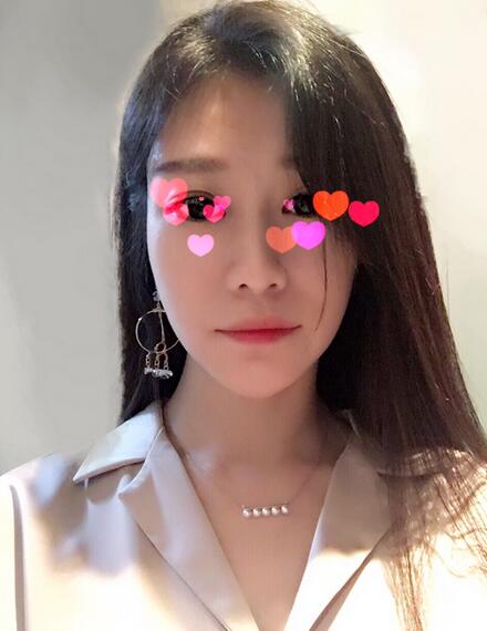 北京葉子磨下頜角整形的果圖