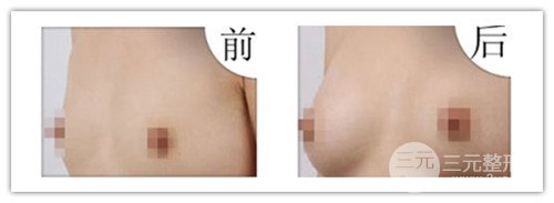 假體隆胸后可以運動嗎，可以鍛煉嗎