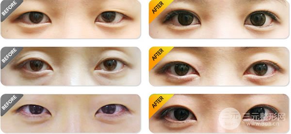 納米微創(chuàng)雙眼皮的果可以保持多少年