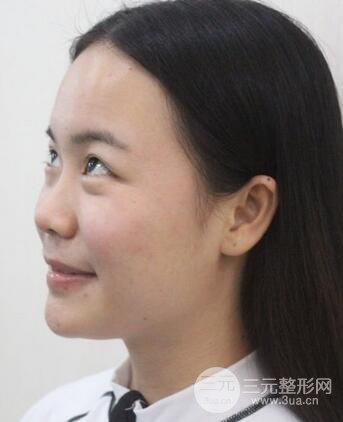 假體隆鼻恢復過程實例 前后果對比