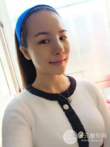 假體隆鼻恢復過程實例 前后果對比