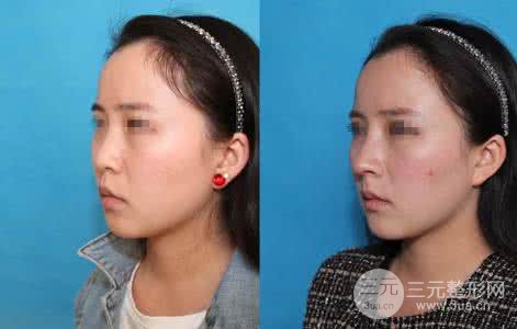假體隆鼻術(shù)后多久可以取出，取出難度高嗎